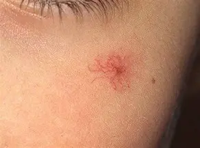 <ol><li><p><span style="color: rgb(209, 23, 23);"><strong>RUQ </strong></span>pain</p></li><li><p><span style="color: rgb(178, 129, 19);"><strong>ascites&nbsp;</strong></span></p></li><li><p><span style="color: rgb(22, 166, 98);"><strong>pruritus</strong></span></p></li><li><p><span style="color: rgb(255, 84, 249);"><strong>confused</strong></span></p></li><li><p><span style="color: rgb(103, 144, 243);"><strong><span>splenomegaly</span></strong><span> → thrombocytopenia</span></span></p></li><li><p><span style="color: rgb(132, 94, 224);"><strong>spider angiomas</strong> (spider-like blood vessels)</span></p></li><li><p><span style="color: rgb(209, 161, 21);"><strong>jaundice</strong></span></p></li><li><p><span style="color: rgb(130, 138, 235);"><strong>GI bleed </strong>(esophageal varices)</span></p></li></ol><p></p>