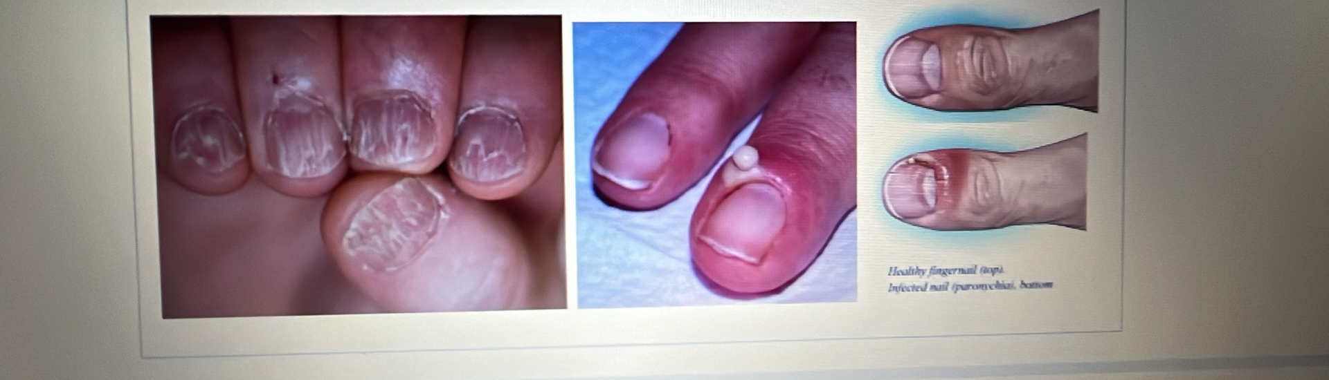 <p>NAIL DISORDER</p><p><span style="font-family: Calibri, sans-serif"><strong>Lichen planus</strong>: A rash that appears as ridges or grooves on your nail.<br><strong>Paronychia</strong>: An inflammation or infection of the tissue directly surrounding your nail</span></p>