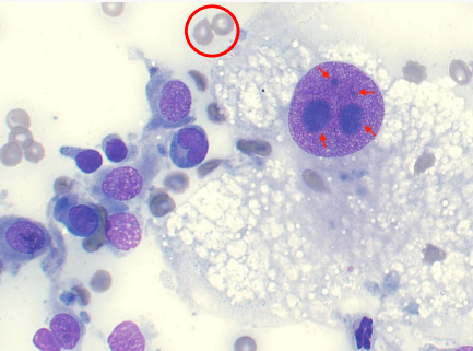 <p>Criteria of malignancy - Nucleoli</p><p>Describe the cell - malignant or no? Why?</p>