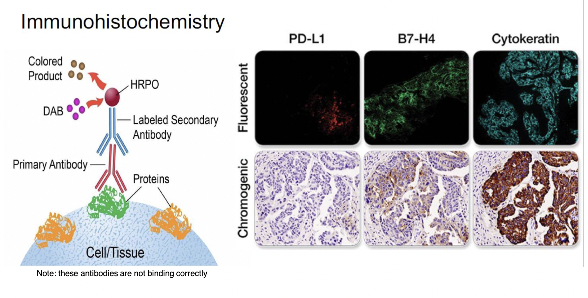 (IHC)

\
immuno = antibodies

histo = tissue

chemistry = binding that occurs bwn the two 

\
a technique used to locate where certain proteins are expressed (and in what cells they’re expressed in) 

\
SUMMARY of steps: 


1. add primary antibody that recognizes the specific protein 
2. add secondary antibody that recognizes the primary antibody and is bound to a fluorescence molecule
3. visualize with microscope where protein is/is not expressed within cells in different tissues

\
DETAILED steps: 


1. PREP: tissue has to be collected + placed on a microtome that functions as a knife to cut the tissues into 3-5 µm sections → a section is placed on a slide 
2. ON THE SLIDE: tissue section is made of cells; on a cell are diff shaped receptors called antigens → these antigens bind to y-shaped molecules called antibodies (made by injecting proteins from tissue sample into an animal)
3. bc the proteins are foreign + bad to the animals, the animals' immune response kicks in and creates antibodies 
4. the antibodies that attach first are called primary antibodies → once the primary antibodies are bound to the cell, secondary antibodies are introduced + those bind to the primary antibody
5. the secondary antibodies are typically bound to a fluorescent tag (made of a FLUOROPHORE molecule) - the specimen is illuminated with a light of a specific wavelength, absorbed by the fluorophores causing them to emit light of longer wavelengths → scientists can visualize the light being emitted by the fluorophores
6. RESULT: can take colorful photos of the protein being expressed