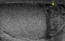 <ol><li><p>This scan was performed on a patient who has STIs. What can be assumed here?</p></li><li><p>Is this pathology isolated or spread?</p></li></ol><p></p>