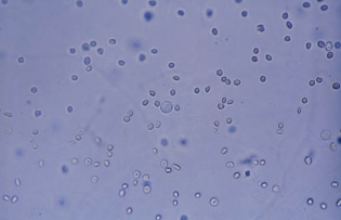 Microcytic and crenated RBCs