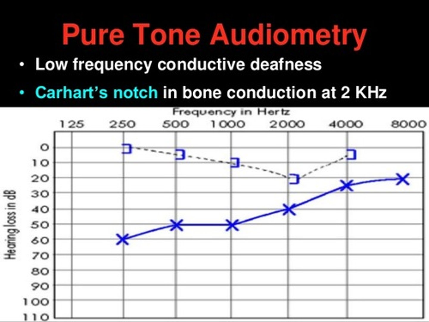 <p>Carhart's notch</p><p>type As tymp in affected ear</p><p>Schwartz sign</p>