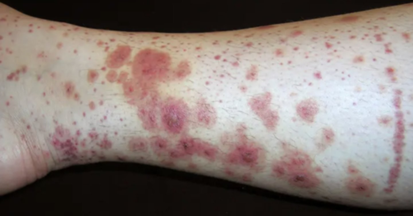 <p>Non-palpable, non-blanching violaceous discoloration of the skin</p>