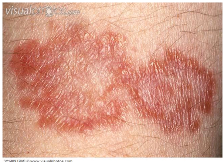 <p>What’s the name? What type of disease? What’s the cause? What’s the trigger?</p><p>What is it characterized by? Hallmark sign? 5 locations it can be at?</p><p>Age range? </p><p>Gender? </p><p>Prognosis?</p>