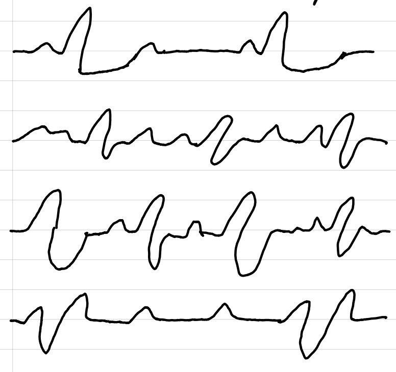 <p>NOT shockable</p><p>activity in the heart that is not tachycardia nor fibrillation</p><ul><li><p>treatment: epinephrine, continuous compressions, look for causes</p></li></ul><p></p>
