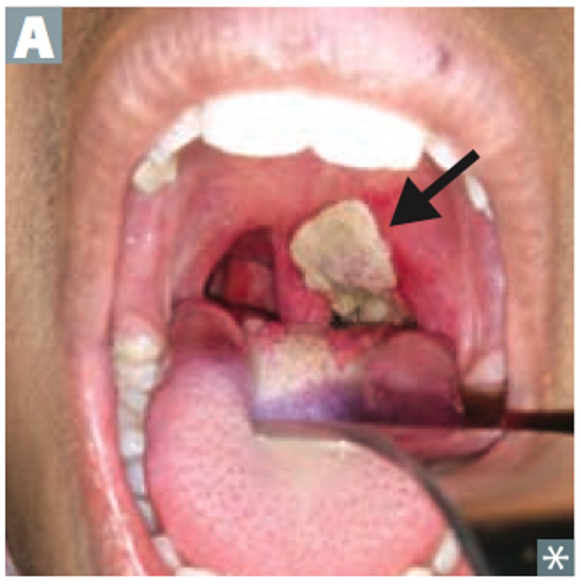 <p>Corynebacterium diphtheriae</p><p>S+S: Inflammation of the pharynx and larynx --&gt; throat pain, dysphagia, fever, headache, enlarged tonsils, enlarged cervical lymph nodes, <strong>tough adherent grayish-white pseudomembrane in throat</strong></p><p>Transmission: Inhalation of or contact with infected oropharyngeal secretions</p><p>Vaccine: DTaP or Tdap</p>