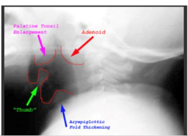 <ul><li><p>Careful positioning for x-rays </p><ul><li><p>Lateral position is used </p></li><li><p>Not supine because airway occlusion could occur</p></li></ul></li><li><p>Thumb Sign </p></li></ul><p></p>