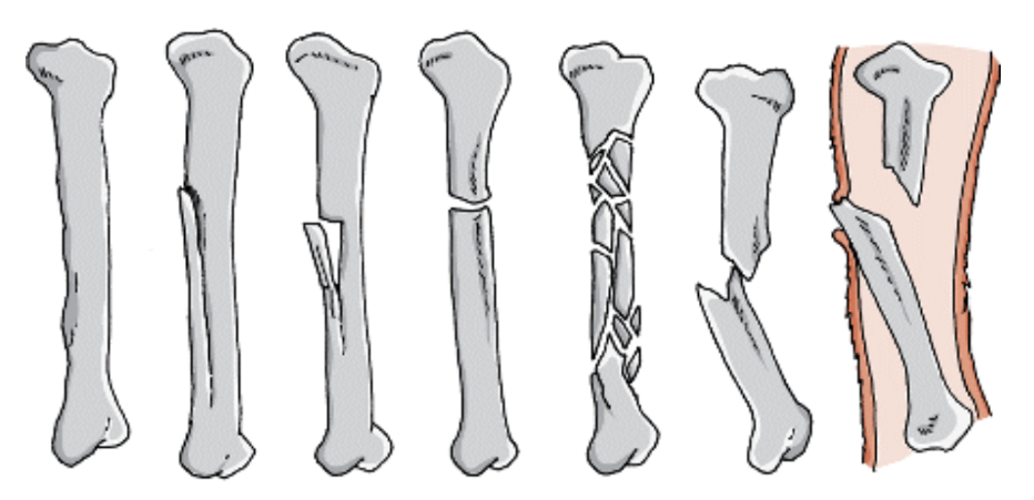 <p>Types of fractures:</p>