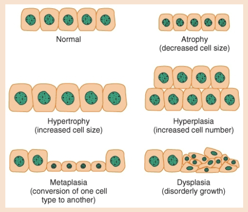 <p><strong>definition</strong>: cells adapting to ongoing stressors</p><p><strong>types</strong>:</p><ol><li><p><strong>atrophy</strong>:<em> cells shrink</em> and functionality reduces</p></li><li><p><strong>hypertrophy</strong>: <em>cell mass increase</em> and augments functionality (takes up space)</p></li><li><p><strong>hyperplasia</strong>: increase in functional capacity r/t <em>increase cell number</em> (i.e. callus)</p></li><li><p><strong>metaplasia</strong>: <em>conversion</em> of one cell type to another</p></li><li><p><strong>dysplasia</strong>: <em>disorganized</em> appearance of cell</p></li></ol>