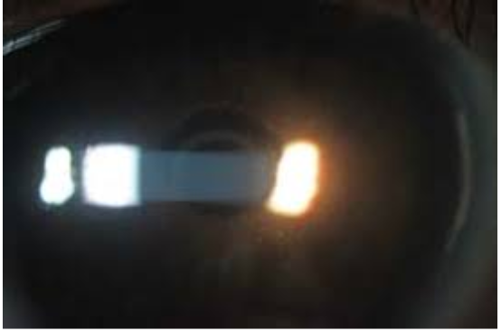 <p>which slit lamp technique is this&nbsp;</p>