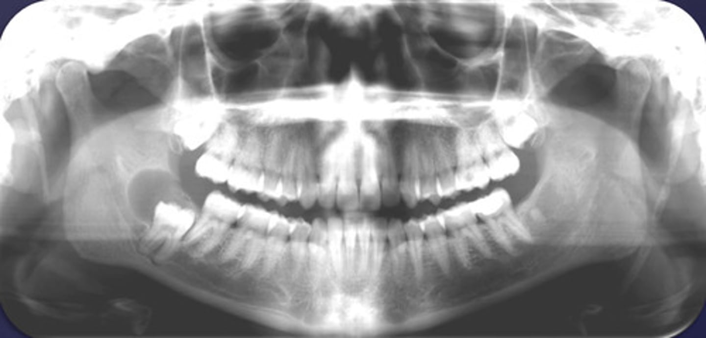 <p>What would be a differential diagnosis for this lesion?</p>
