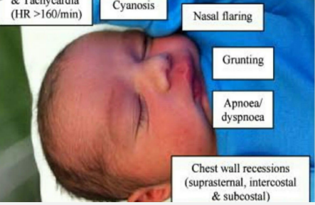 <p><strong>RDS: Symptoms</strong></p><p>-Presents within a few _________ to hours after birth&nbsp;</p><p>-__________</p><p>-Nasal flaring</p><p>-Expiratory grunting&nbsp;</p><p>-Intercostal/subcostal ____________</p><p>-________/hypoxemia or pallor</p><p>-Decreased breath sounds</p><p>-Diminished peripheral pulses&nbsp;</p><p>-Possible peripheral ______</p>