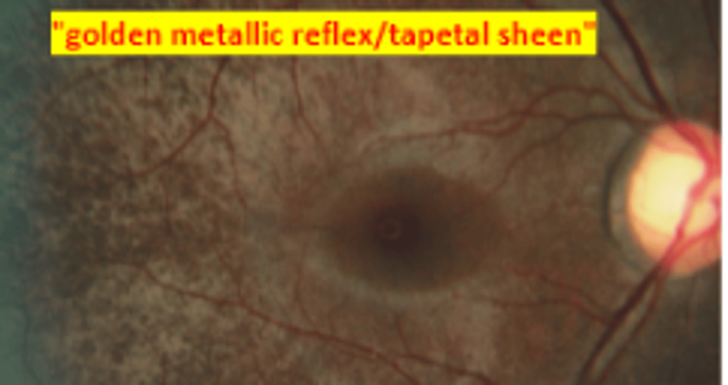 <p>inheritance of retinitis pigmentosa that is the least common and most severe.</p>