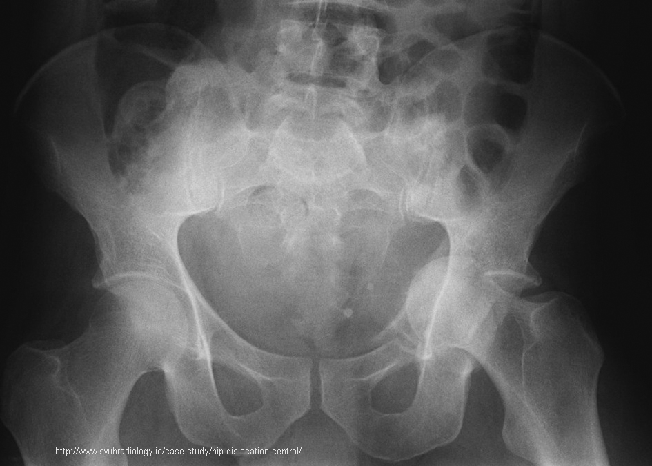 <p>Forced through the acetabulum into the pelvic cavity.</p>