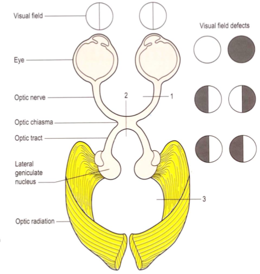 <p>Damage to the area of which number correlates with which visual field defect</p>