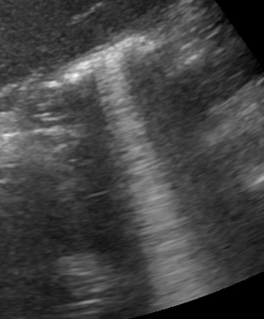 <p>Air/gas reverberation in emphysematous cholecystitis </p><p>Ring down artifact is a special type of resonance artifact </p><p>Appearance is similar to the ladder-like reverberation of comet-tail artifact but it is produced by a completely different mechanism </p>