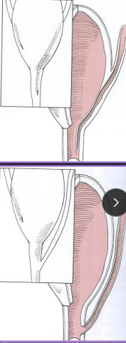 <p><span>Ectopic Ureter</span></p>