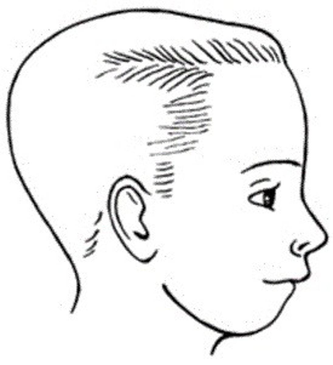 <p>Prominent maxilla and a mandible posterior to its normal relationship</p>