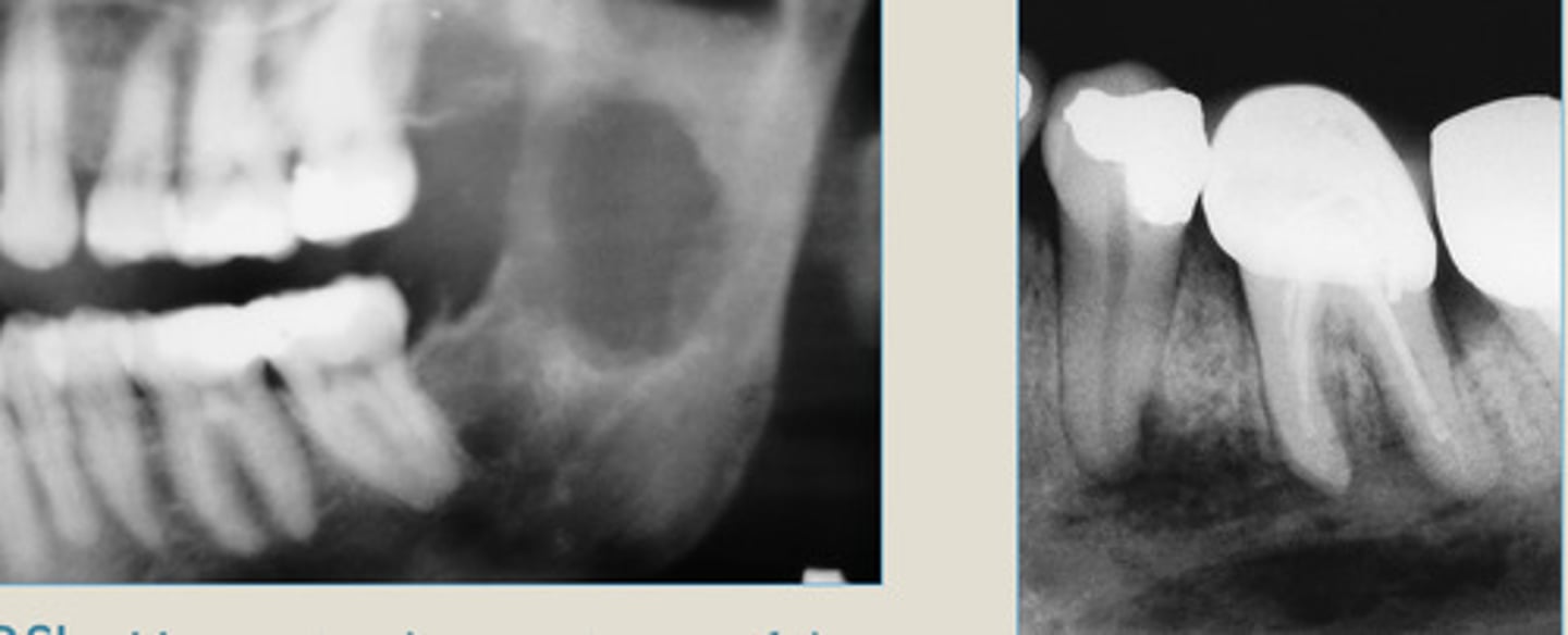 <p>irregular, pure lucency</p><p>"moth-eaten" bone destruction</p>