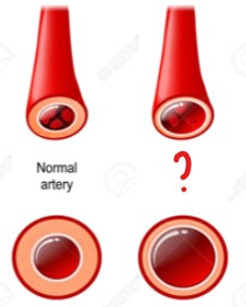 <p>The artery on the left is affected by vaso(dilation/constriction).</p>