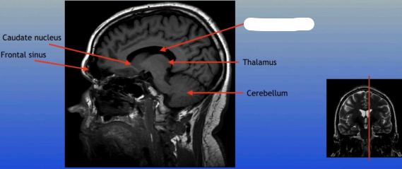 <p>A fluid-filled cavity located within each hemisphere of the brain, part of the ventricular system, that helps cushion the brain and circulate cerebrospinal fluid. </p>
