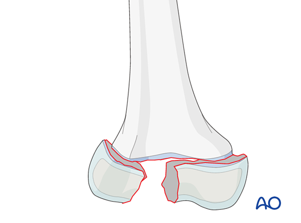 <ul><li><p>a fracture that occurs in a growth section of a child’s bone and may result in growth abnormalities </p></li></ul><p></p>