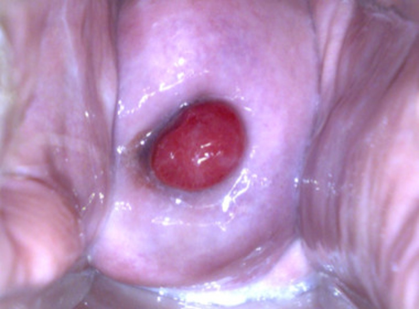 <p>Cervical polyps: </p><p>may be single or multiple, usually <3cm in diameter</p><p>lobular/pear-shaped, stalk arises from cervical canal and size varies</p><p>1. Often asymptomatic and incidentally dx</p><p>2. postcoital or intermenstrual bleeding </p><p>Management:</p><p>1. SDM- observation (education to report irregular or postcoital bleeding) or removal for histology (indications are symptoms such as irregular or postcoital bleeding, increased discharge, larger than 3cm, necrotic, friable, irregular</p><p>color)</p><p>2. if stalk is clearly visible, removal is simple and in office. GRab polyp, clamp and apply pressure for 3-5 minutes, twist forceps to remove polyp. May bleed-can cauterize</p>