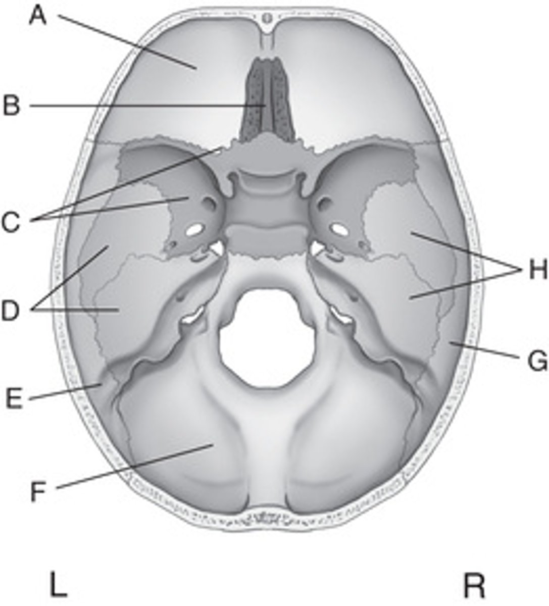 <p>A. Frontal</p><p>B. Ethmoid</p><p>C. Sphenoid</p><p>D. Left temporal</p><p>E. Left parietal</p><p>F. Occipital</p><p>G. Right parietal</p><p>H. Right temporal</p>
