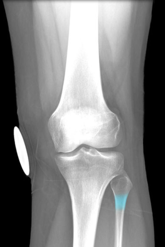 Location:
Fibula (superior)
Between head and shaft
Description:
Constricted part between head and
shaft