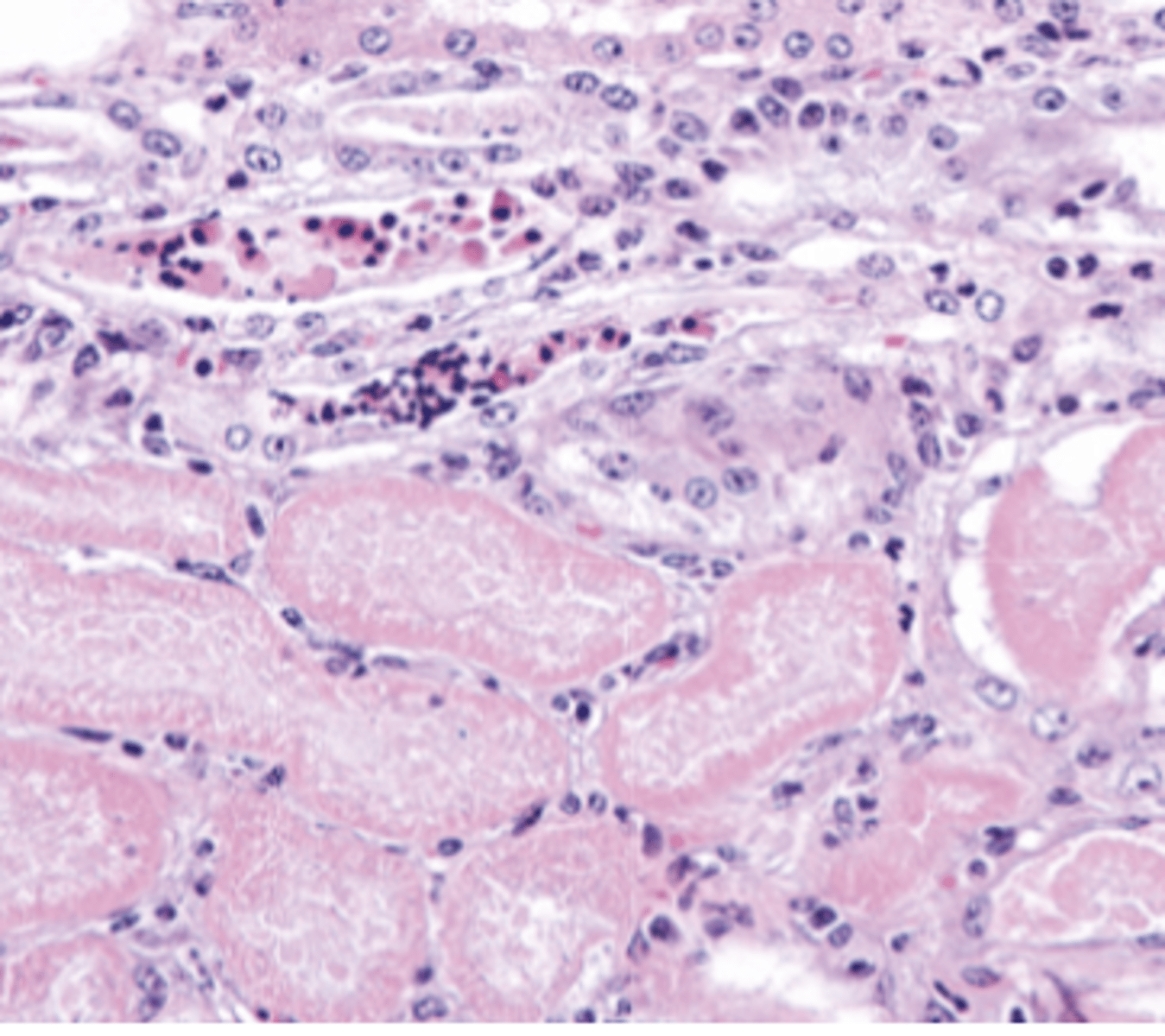 <p>What type of necrosis is being shown in this photo?</p>