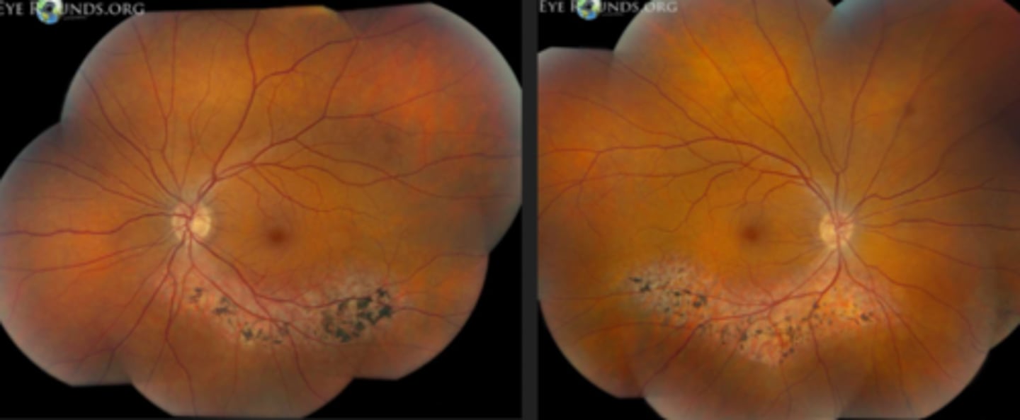 <p>variant of RP = only certain regions show degeneration, but is still symmetrical between eyes </p>