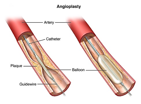 <p>inserting a balloon into artery to smash plaque against wall to open up vessel</p>