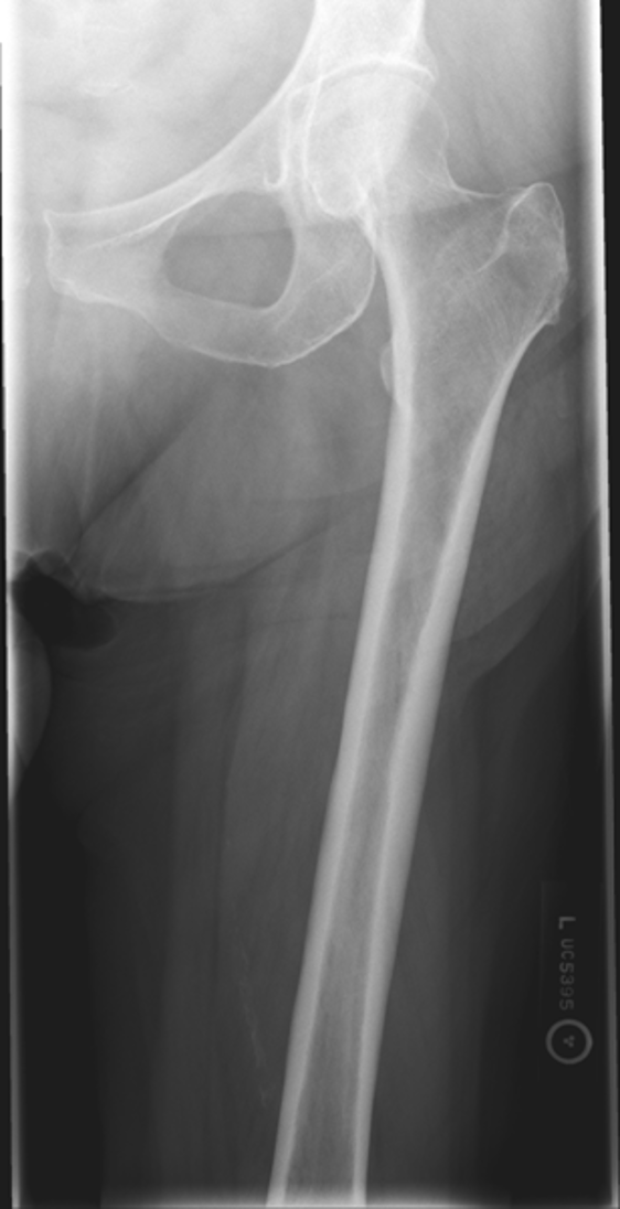 <p>what is the image critique of this AP femur?</p>