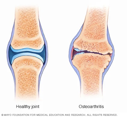 <p>No cartilage between bones of joints </p>