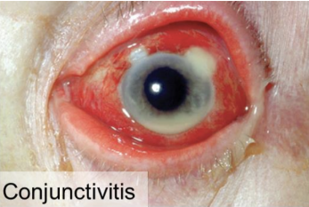 <p>Inflammation of the conjunctiva (“pink eye”).</p>