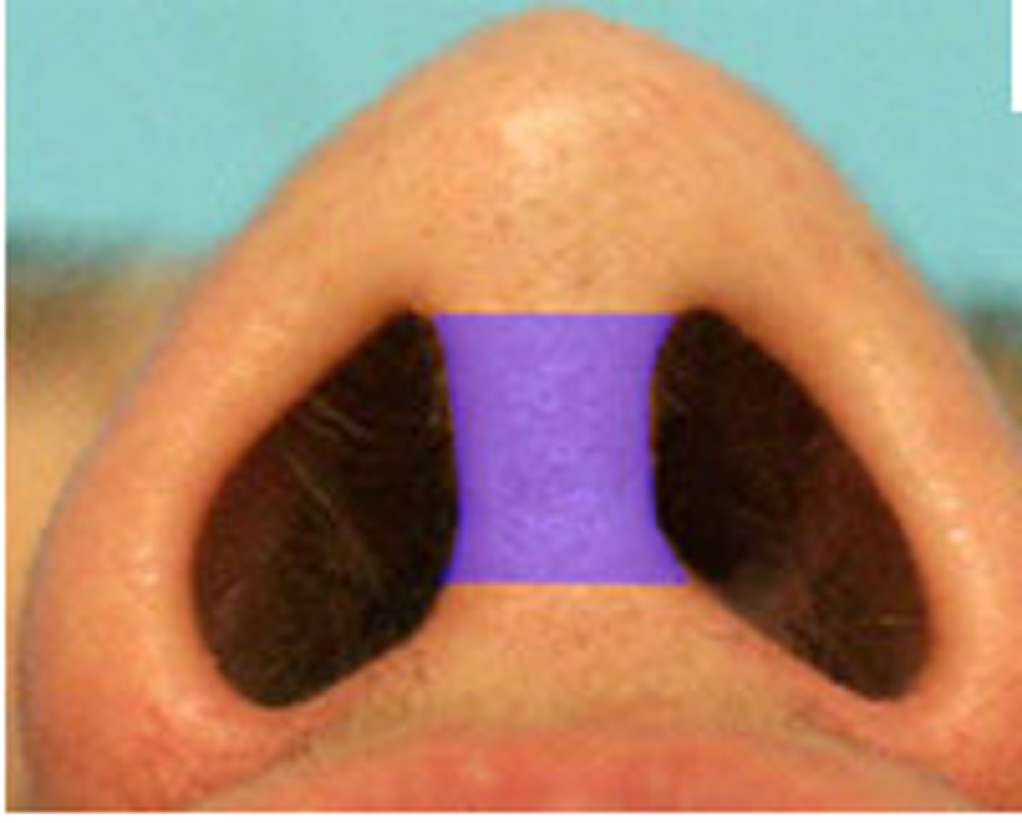 <p>most anterior portion of the nasal septum</p>