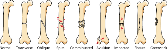 <ul><li><p><span style="color: rgb(0, 0, 0)">Bone broken ends protrude through skin</span></p></li></ul>