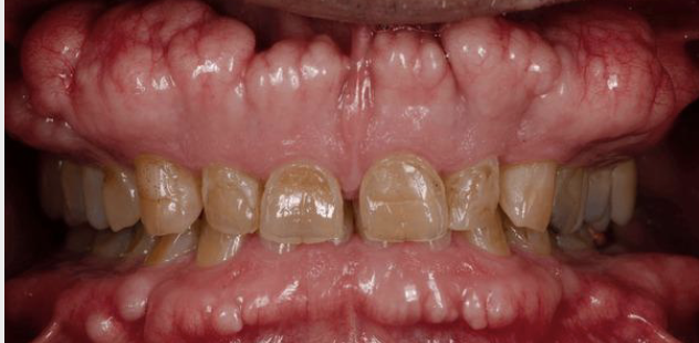 <ul><li><p><span style="color: #000000">Localized bony protuberance that arise from the cortical plate</span></p></li><li><p><span style="color: #000000">Maybe due to stress placed on the bone</span></p></li><li><p><span style="color: #000000">Buccal, palatal, torus</span></p></li></ul><p></p>