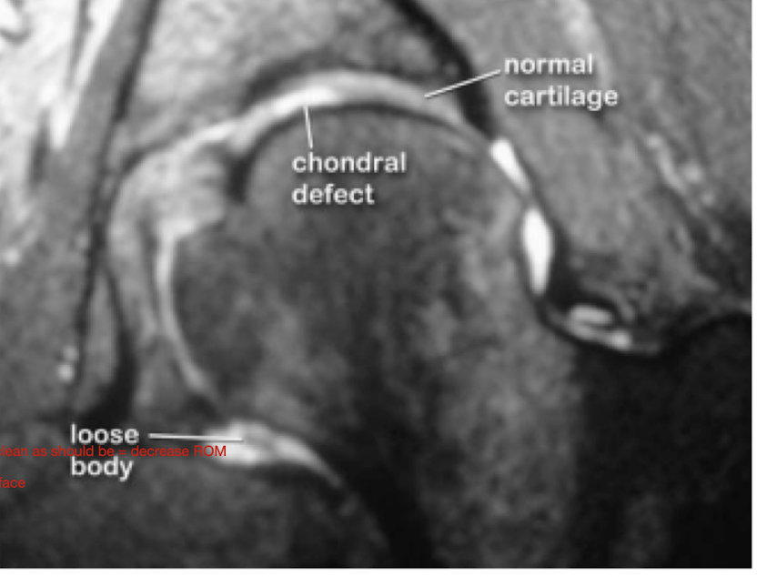 <p>Chondral Defect: S/S</p><ul><li><p>What activities would this pt complain of having difficulty doing?</p><ul><li><p>3</p></li></ul></li></ul><p></p>