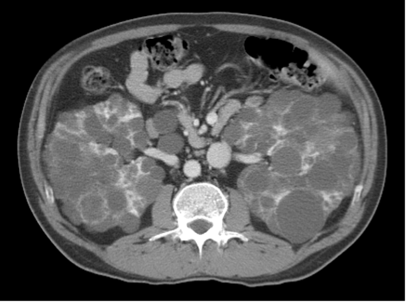 <p>A 40-year-old with a known history of a genetically inherited kidney disease presents for follow-up. They have well-controlled hypertension and report no current urinary symptoms. PE is unremarkable and their most recent CT is obtained.</p><p>Which of the following is an extra-renal manifestation most commonly associated with this condition?</p>