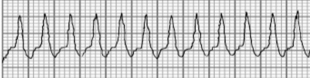 <p>What type of arrhythmia is this? </p>