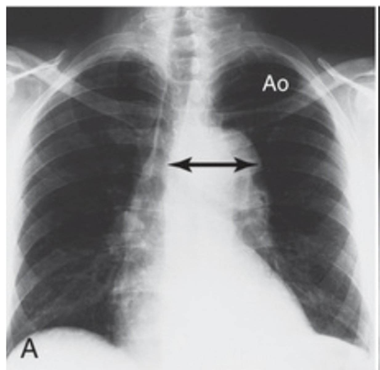 <p>- widening of the ascending aorta or aortic arch</p>