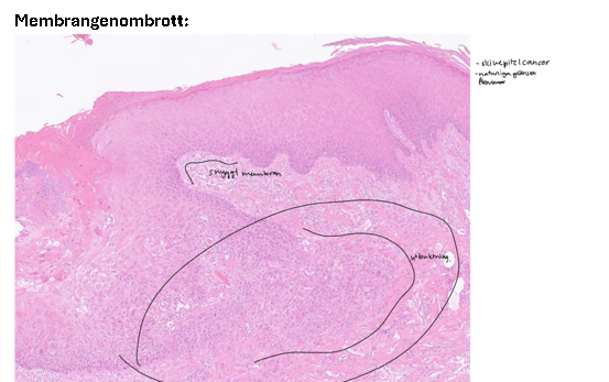 <p>14- Vad är cancer och när övergår atypi till cancer?</p>
