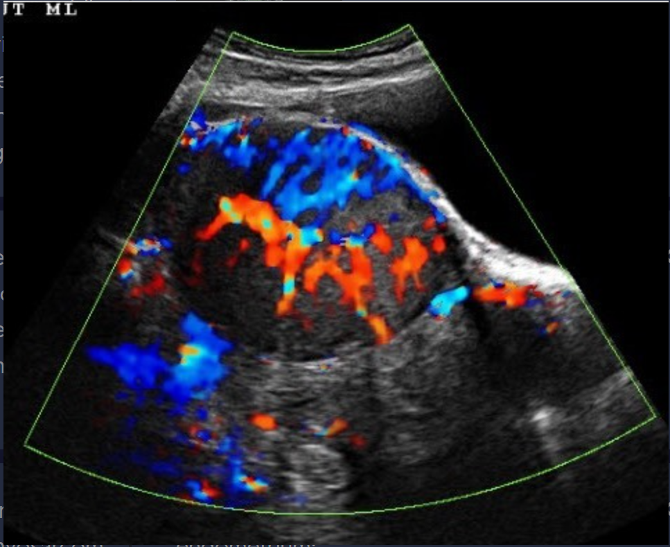 <p>Uterine leiomyosarcoma is a ____, rapidly growing aggressive uterine malignancy that accounts for ___ of all uterine malignancies </p>