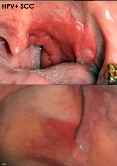 <p>What is the management of erythroplakia?</p>