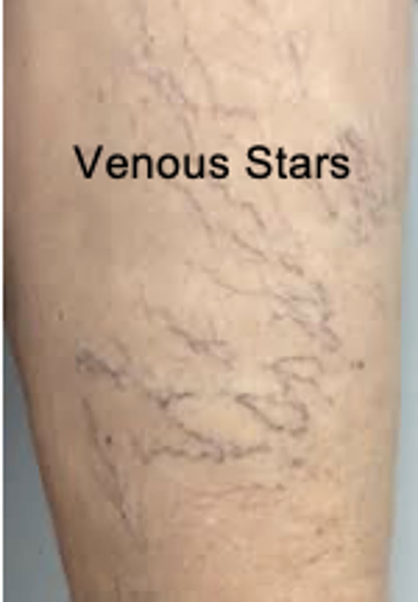 <p>blue-purple dilation of venules and capillaries in a star-shaped, linear, or flaring pattern. Pressure causes them to empty or disappear. Located on the legs near varicose veins and also on the face, lips, ears, and chest.</p>
