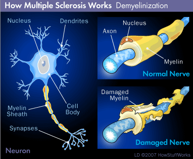 <p>the immune system attacks the myelin, which becomes destroyed in many areas.</p><p>This loss of myelin forms scar tissue called sclerosis</p>