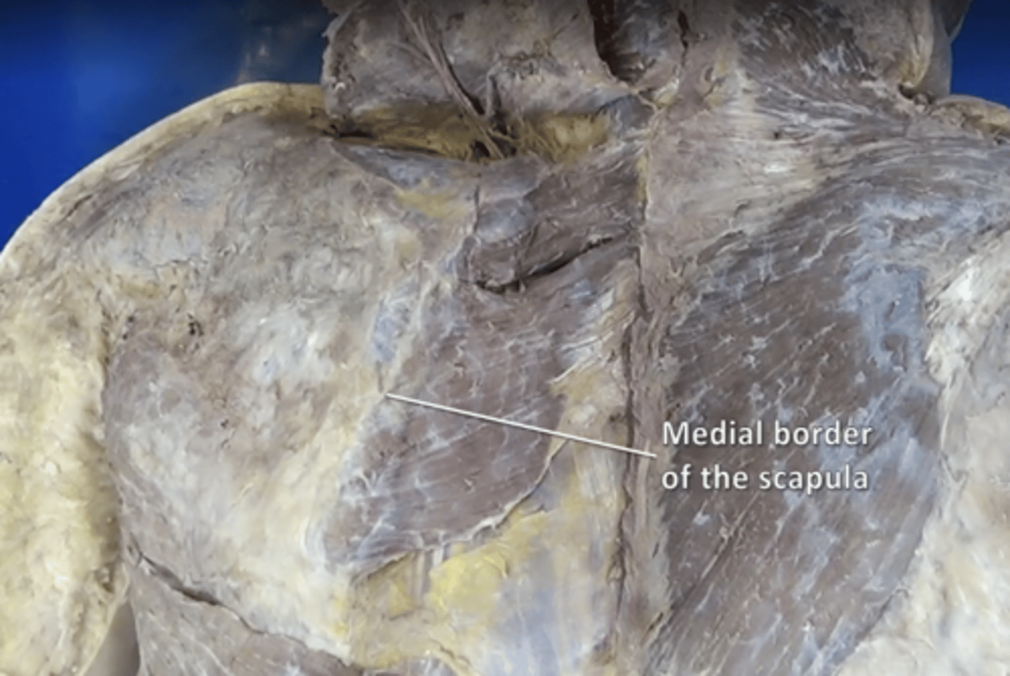 <p>serratus anterior insertion</p>