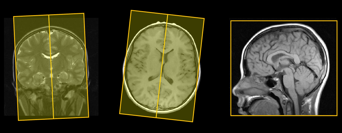 <p>Slice angulation for sagittial IAC: coronal and axial </p>